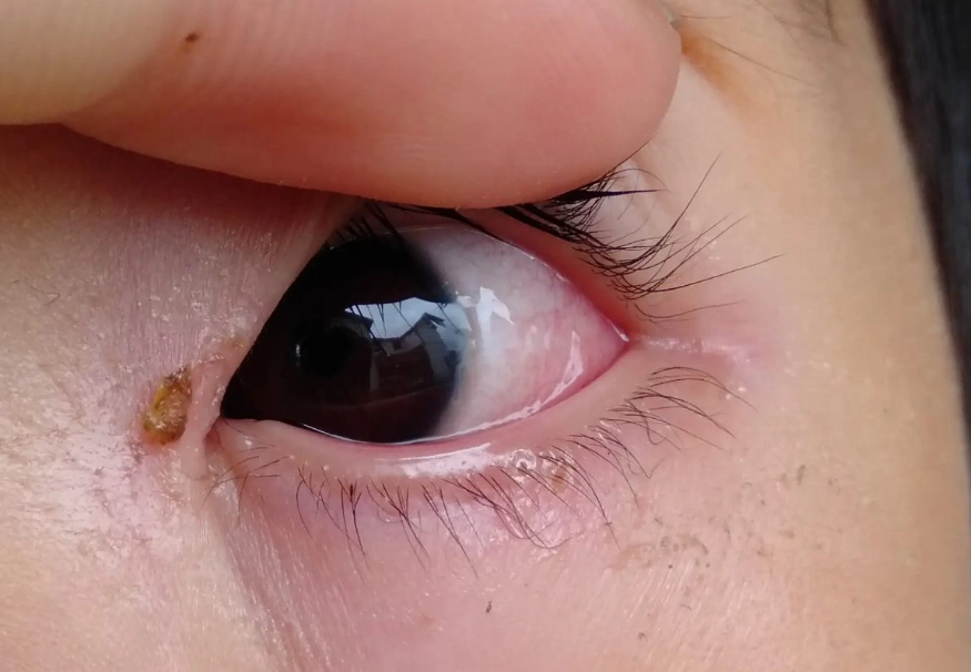 结膜炎 结膜炎