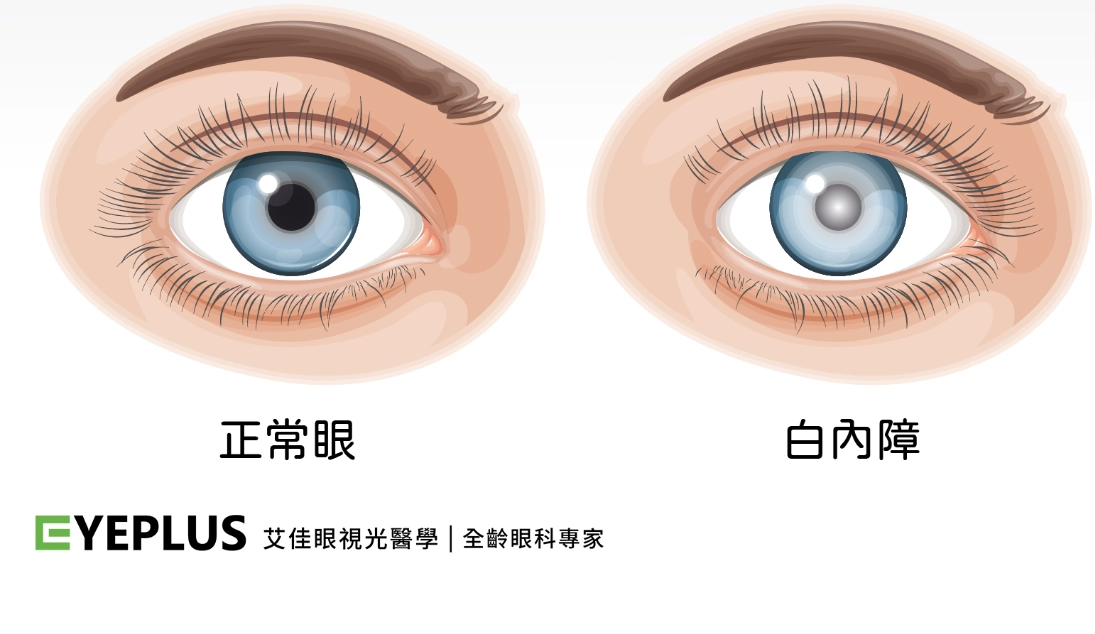 前葡萄膜炎治療