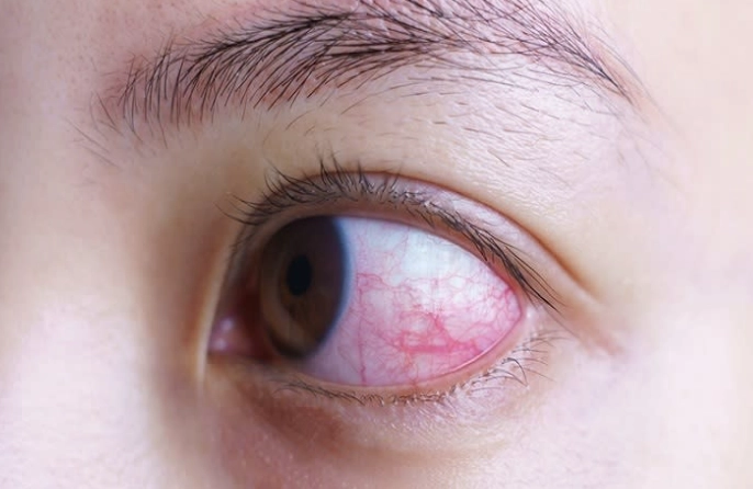 眼睛發炎怎麼辦