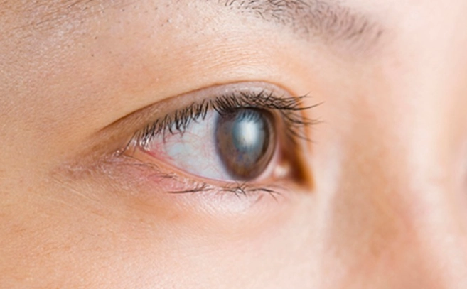 過敏性結膜炎傳染