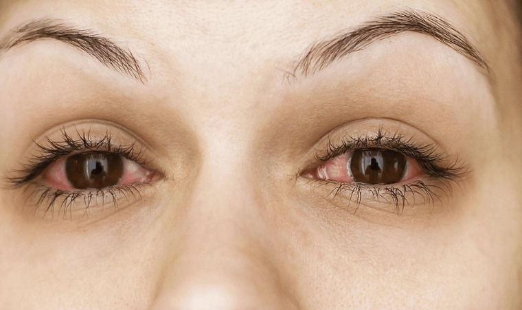 眼睛發炎怎麼辦