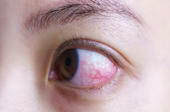 眼白粉紅色